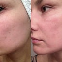 Here's a before and after - the after being six days later. This is my left cheek.