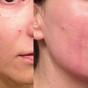 Here's a before and after - the after being six days later. This is my right cheek.