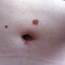 Belly button at 3 months.