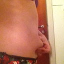 Before procedure side view - pinching fat