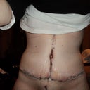 A few days after surgery