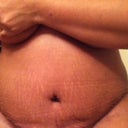5 days post op, sorry for all the extra outside of stomach ladies. lol
