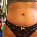 7 months PO. Front view covering scar with panty