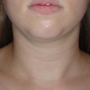 4 Weeks Post - Front