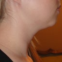 4 Weeks Post - Right