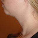 4 Weeks Post - Left