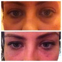 Night before injections and about 5 mins after injections. Bruising is now gone and looks great!