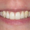 Tray 13/15 - no aligner