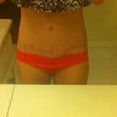 21 weeks scar. Fading!