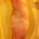 side view. 14 days post op
