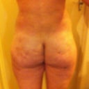 rear view. 14 days post op