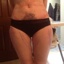next day post op