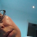 4 weeks after 2nd treatment right cheek