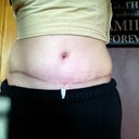 2 weeks and 2 days post. Scar healing great. Swelling is down.