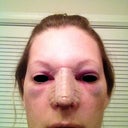 DAY AFTER SURGERY