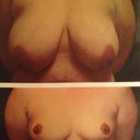 9.5 weeks vs. pre op surgeon comparison. 