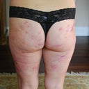 ugh.   Bum, 2 days post procedure.   It aches and is so sore, but not painful, just uncomfortable.