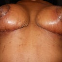 4 Weeks PO - the dreaded scar shot (under the boobs)