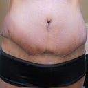 4 Weeks PO. These panties only cover the lowest bit of the incision, like most of my panties.