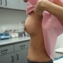 1 day post op