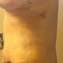 PO Day 11, first thing this morning after my shower, still swollen but getting better....