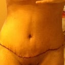 PO Day 11, front view, starting to see some improvement with swelling going down, YAY!