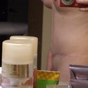 6 months post op side view