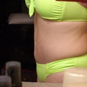 sideview 6 months post op of tt getting additional lipo of the abs in two days