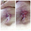Under right breast....Silvadene seems to be working! 
Pic on right was on 1/30, left is on 2/3