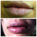 my lips before and about 15 minutes post op.