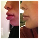 swelling 1 day post op vs. 3 days post op. I am posting this for those who didn't know how much swelling was normal because most people don't post pics until their final results.