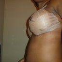 1 day post op.