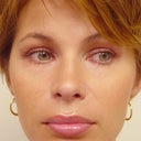 Lip Augmentation