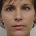 Lip Augmentation