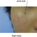 1 cm scar from an accident