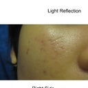 lots of acne scar and redness!! :(