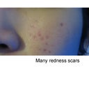 Acne scar and redness!!!!