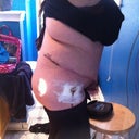 swelling day 23 from the right side...and my BEST friend who NEVER leaves...MR. Drain!!! :)