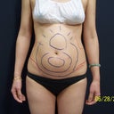 Before Smartlipo 