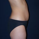Before Smartlipo 