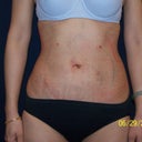 1 day after Smartlipo