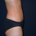 1 day after Smartlipo
