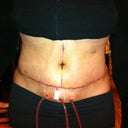 3 Days Post Op