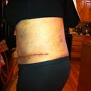 3 Days Post Op