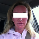 Hot Tamale Red.  Right after my Profractional Treatment