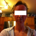 Yes, that's blood on my face. The night of Profractional Treatment, you can't wash your face till the next morning