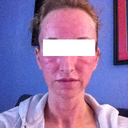 As you can see, there is swelling around my eyes but things are starting to look better :)