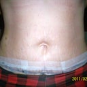 Day #5 post op tummy tuck front view