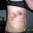 Day #5 post op tummy tuck side view
