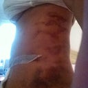 Holy bruises batman, no wonder Im in pain! lipo worse then tuck!